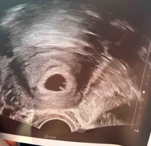 Bild zu Ultraschall 6+1 - Forum für Februar - Mamis