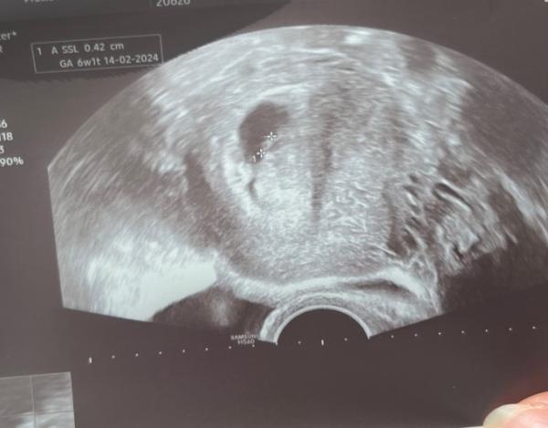 Bild zu 1. ultraschall bild 6+0 - Forum für Februar - Mamis
