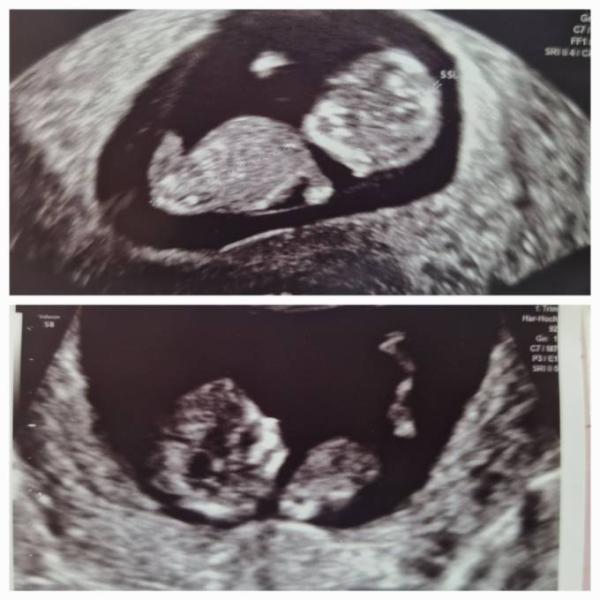 Bild zu Mädl oder Junge? 12 ssw - Forum für Februar - Mamis