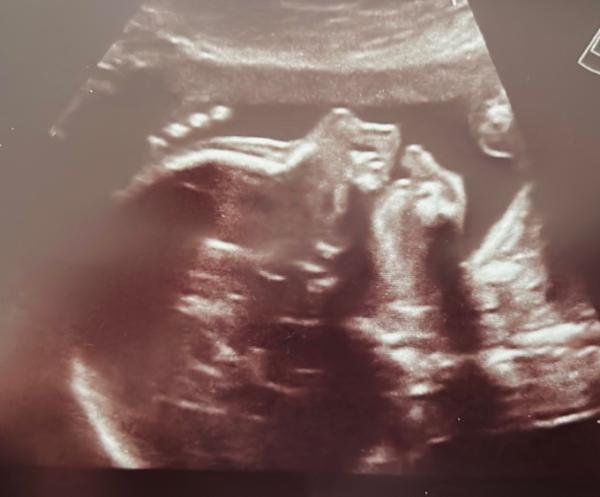 Bild zu Feinultraschall - Forum für Februar - Mamis