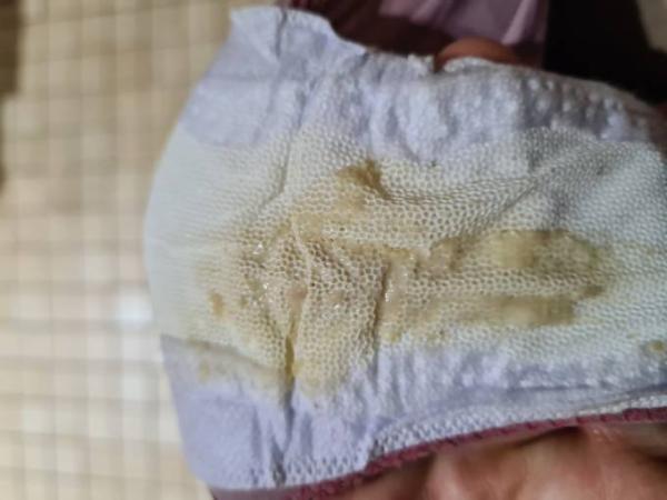 Bild zu Komischer Ausfluss ACHTUNG BILD - Forum für Februar - Mamis