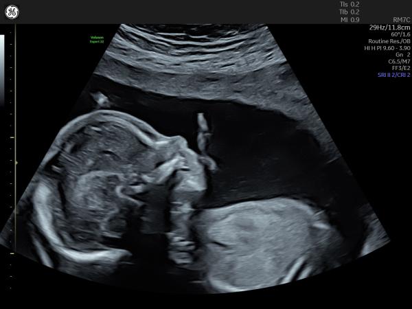 Bild zu Heutiger Organultraschall🩵 - Forum für Februar - Mamis