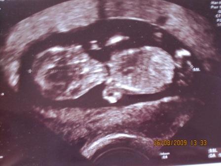 Bild zu Versprochener Bericht zur VU am Montag - Forum für März - Mamis