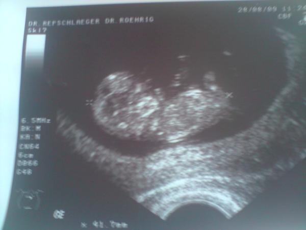 Bild zu bild vom baby 10+5 (vom freitag) - Forum für März - Mamis