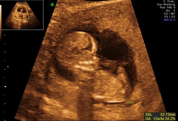 Bild zu VU-Bericht mit Bild - Forum für März - Mamis