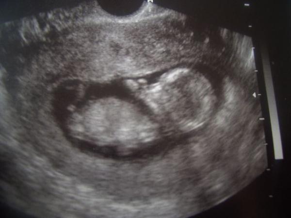 Bild zu Zwei Ultraschallbilder euch zeigen möchte.... - Forum für März - Mamis