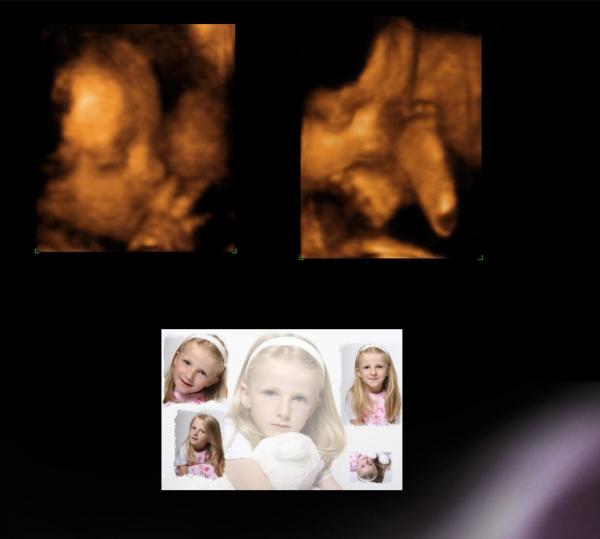 Bild zu 3D-Foto von meiner kleinen und foto von grossen darunter - Forum für März - Mamis