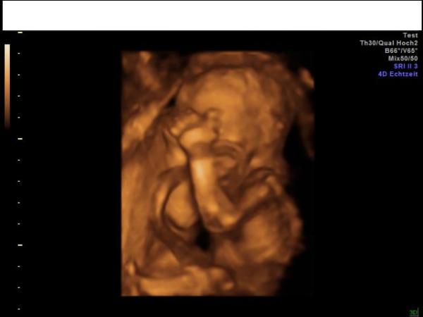 Bild zu Heute VU gehabt - Forum für März - Mamis