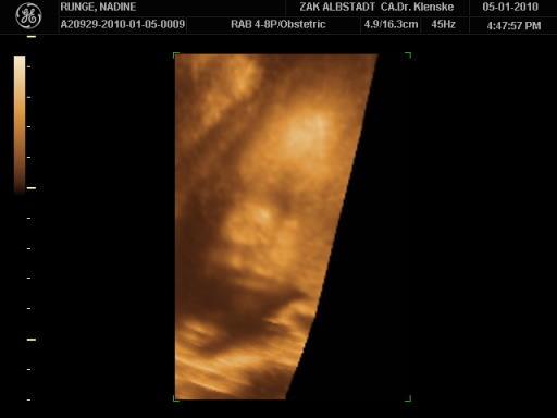Bild zu gestern beim 3d-ultraschall - Forum für März - Mamis