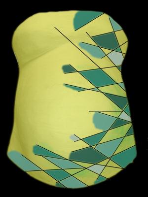 Bild zu nochmal Entwurf Gipsbauch - Forum für März - Mamis