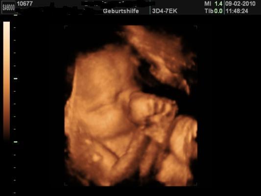 Bild zu VU Bericht mit 3D Foto - Forum für März - Mamis