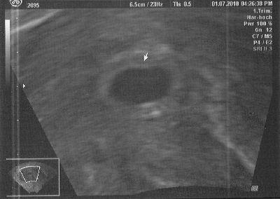 Bild zu Dann zeige ich auch mal mein 1. Ultraschallbild... - Forum für März - Mamis
