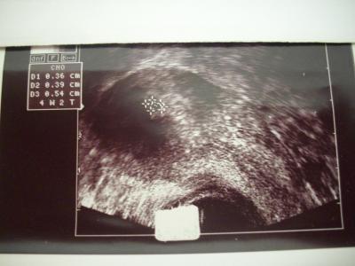 Bild zu Ultraschallbild 4.Woche + 2 Tage :-) - Forum für März - Mamis