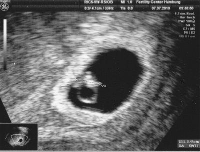 Bild zu KiWu-Klinik-Ultraschall - Forum für März - Mamis
