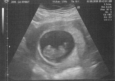 Bild zu So - und nun das Ultraschallbild - Forum für März - Mamis