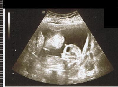 Bild zu Hier mein US Bild.. - Forum für März - Mamis