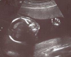 Bild zu So jetzt zeig ich auch mal ein Ultraschallbild - Forum für März - Mamis