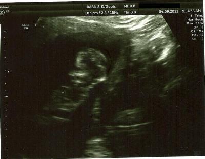 Bild zu Hatte dienstag Kontrolle wegen Hämatom!+Foto - Forum für März - Mamis