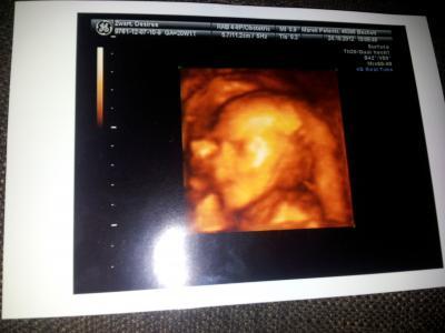 Bild zu Ultraschall bild von gestern - Forum für März - Mamis