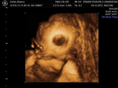 Bild zu Bild 3D Ultraschall mit Vorderwandplazenta - Forum für März - Mamis