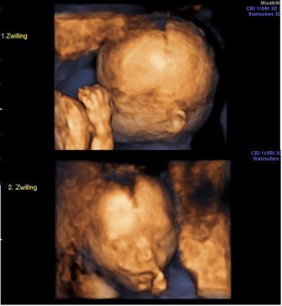Bild zu Gestern wieder pränatale Diagnostik - Forum für März - Mamis