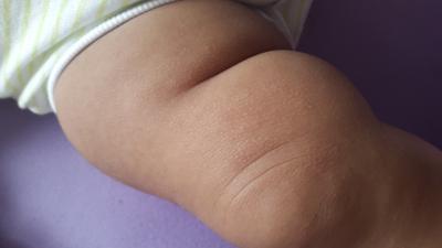 Bild zu Pickelchen - Forum für März - Mamis
