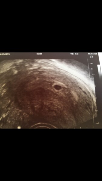 Bild zu Die unrunde fruchtblase... - Forum für März - Mamis