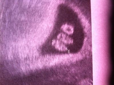 Bild zu Zwillinge Ultraschall - Forum für März - Mamis