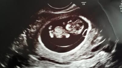 Bild zu Ultraschall:) - Forum für März - Mamis