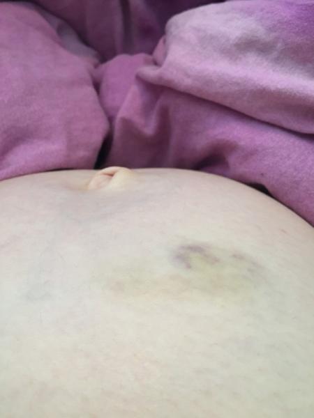 Bild zu kleiner Bluterguss am Bauch - Forum für März - Mamis