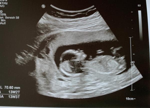 Bild zu Heute Ersttrimester Screening / Erkennt jemand was? - Forum für März - Mamis