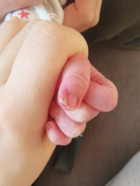 Bild zu Nagelbettentzündung? Hilfe! - Forum für März - Mamis