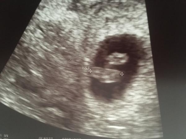 Bild zu Erster Ultraschall - Forum für März - Mamis