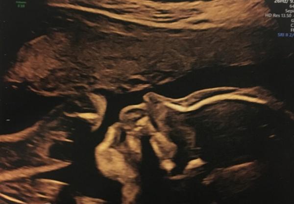 Bild zu Organscreening 2ter US ❤️ - Forum für März - Mamis