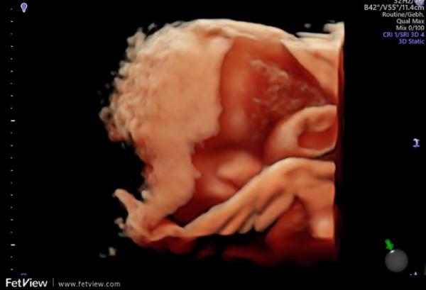 Bild zu Ultraschall - Forum für März - Mamis