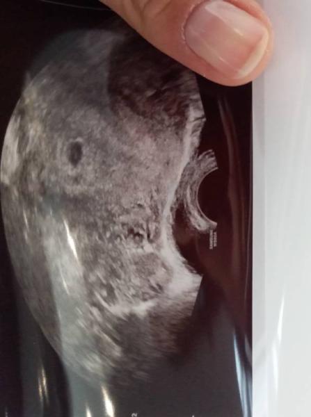 Bild zu Kleine fruchthöhle in 6 ssw - Forum für März - Mamis