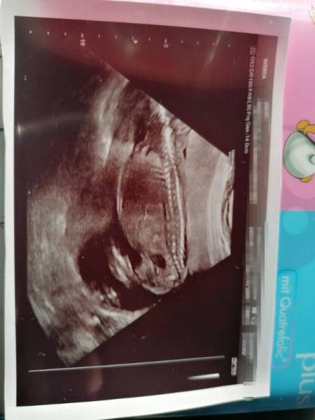 Bild zu Ultraschall junge oder Mädchen - Forum für März - Mamis