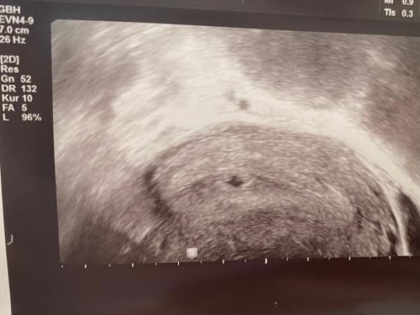 Bild zu Erstes Ultraschallbild, HCG Wert - Forum für März - Mamis