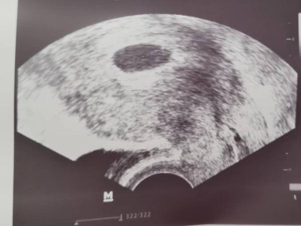 Bild zu 1. US- 6.2 -normal? - Forum für März - Mamis