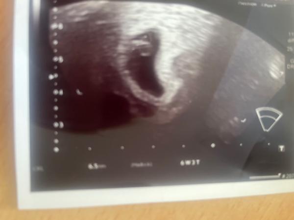 Bild zu Ultraschall  - Forum für März - Mamis
