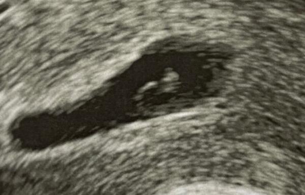 Bild zu US Update SSW 6+1 - Forum für März - Mamis