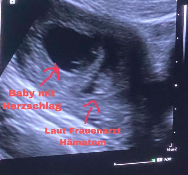 Bild zu Hämatom oder Zwillinge? - Forum für März - Mamis