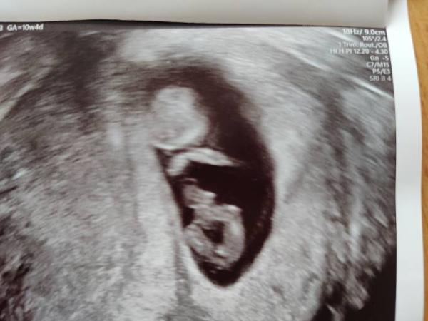 Bild zu Aktuelles Ultraschallbild mit Geschlecht, 11.ssw - Forum für März - Mamis
