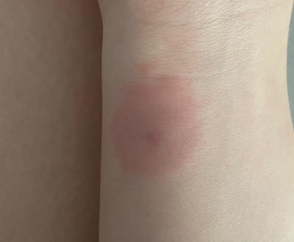 Bild zu Ist das ein verdacht auf Borreliose ? - Forum für März - Mamis