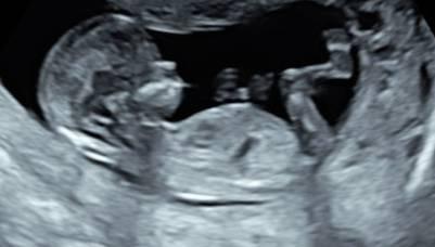 Bild zu Ultraschall - Forum für März - Mamis