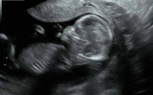 Bild zu Heute pränataldiagnostik - Forum für März - Mamis