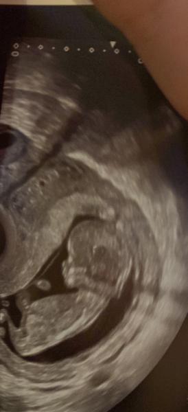 Bild zu Update + US Bild 🥰🥰 - Forum für März - Mamis