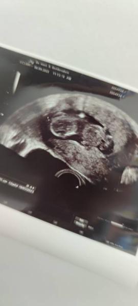 Bild zu Ultraschall SSW13 - Forum für März - Mamis