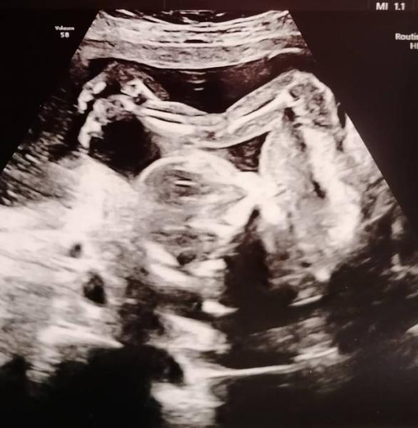 Bild zu 2 MKP Untersuchung mit wsl. Outing - Forum für März - Mamis