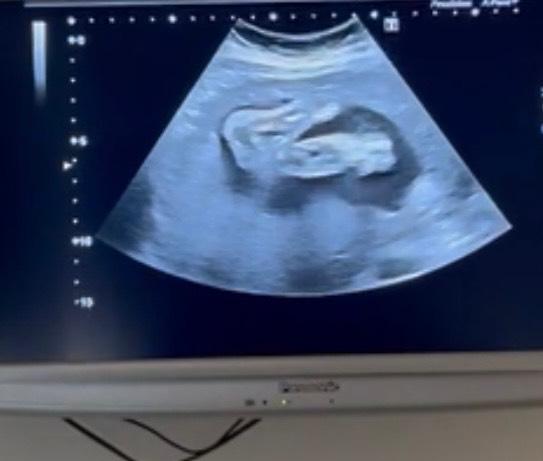 Bild zu Update 3. Ultraschall :) - Forum für März - Mamis